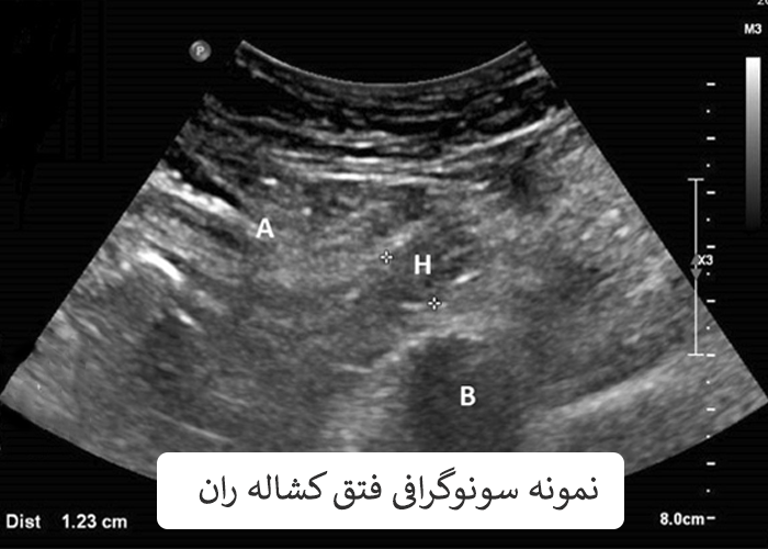 سونوگرافی فتق