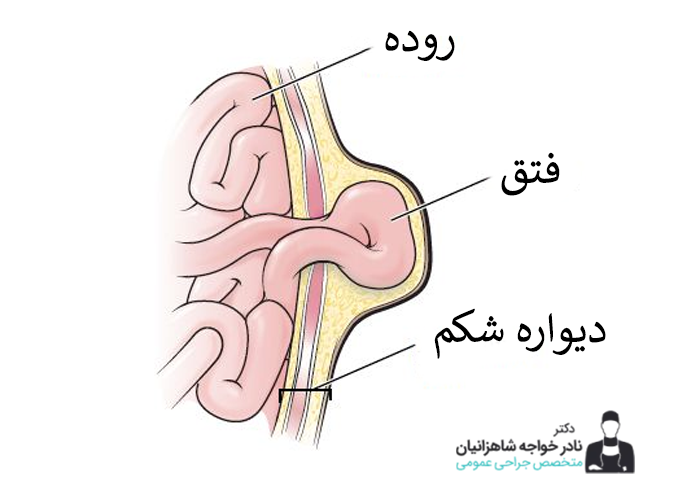 فتق در مردان
