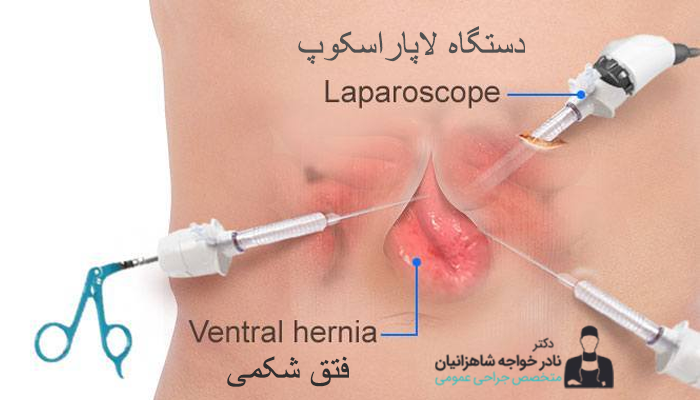 لاپاراسکوپی فتق شکمی