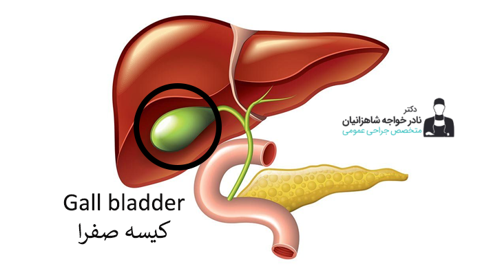 درمان پولیپ کیسه صفرا در قزوین