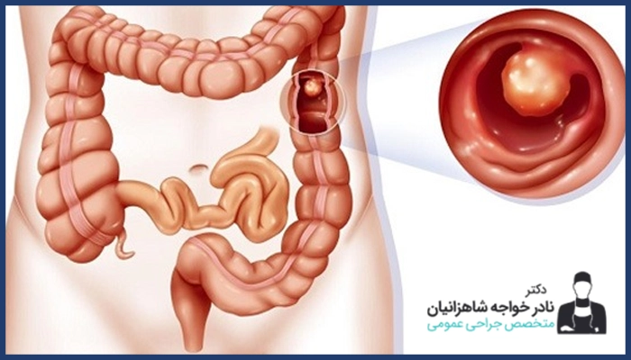 علت ایجاد انسداد روده